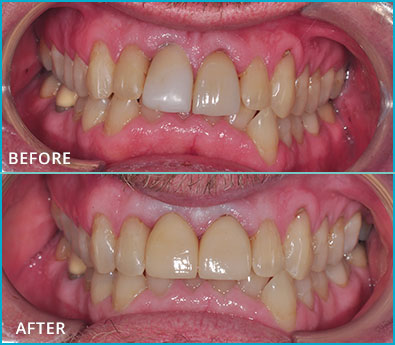 Before and After Case 1