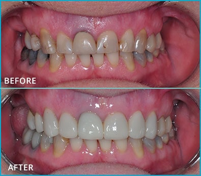 Before and After Case 4