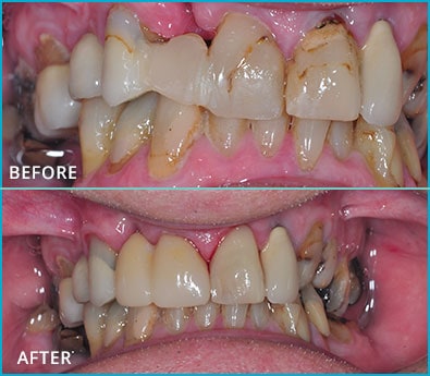 Before and After Case 5