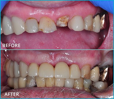 Before and After Case 6