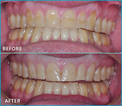 Before and After Case 10