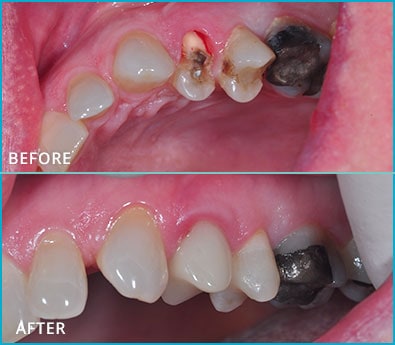 Before and After Case 11