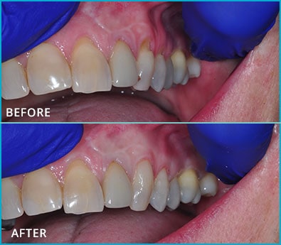 Before and After Case 12