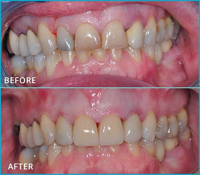 Before and After Case 13