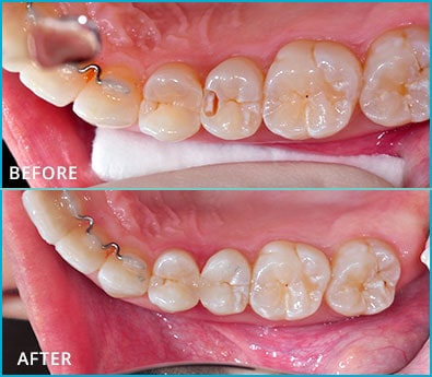 Before and After Case 14