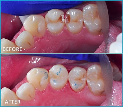 Before and After Case 15