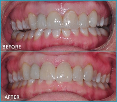 Before and After Case 17