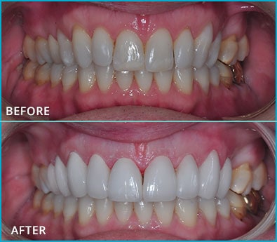 Before and After Case 18