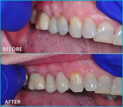 Before and After Case 20