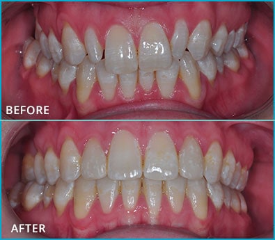 Before and After Case 21