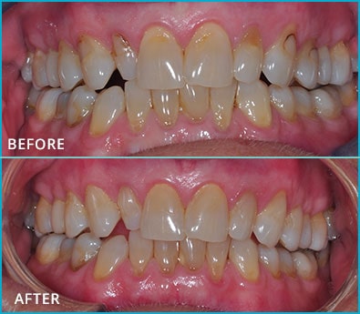 Before and After Case 22