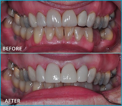 Before and After Case 23