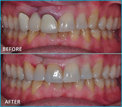 Before and After Case 24