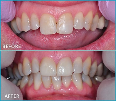 Before and After Case 25