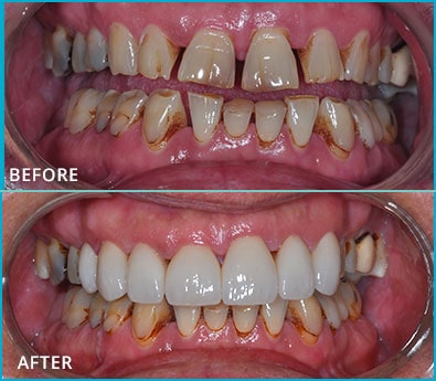 Before and After Case 26