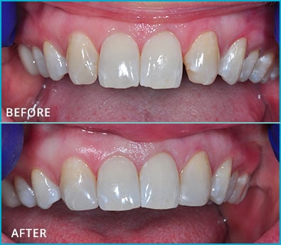 Before and After Case 27