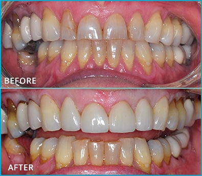 Before and After Case 28