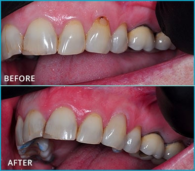 Before and After Case 30