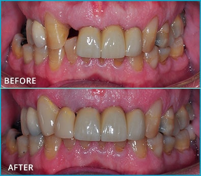 Before and After Case 31