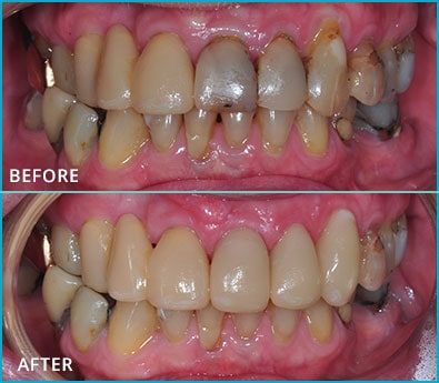 Before and After Case 32