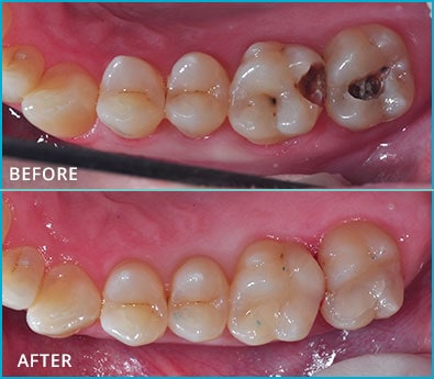 Before and After Case 33