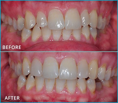 Before and After Case 34