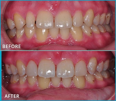 Before and After Case 35