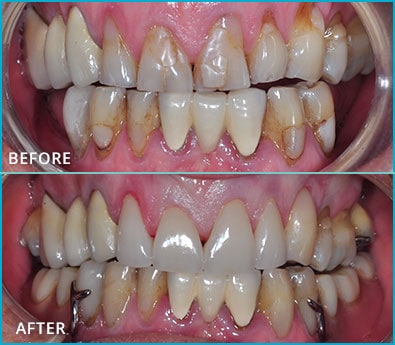 Before and After Case 36