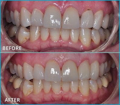 Before and After Case 37