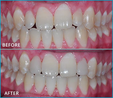 Before and After Case 38