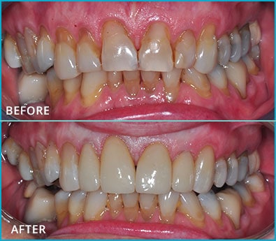 Before and After Case 40