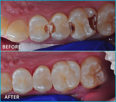 Before and After Case 41