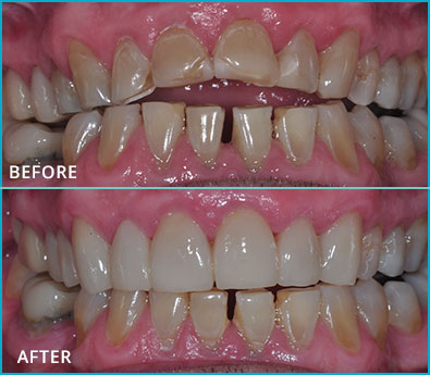 Before and After Case 43