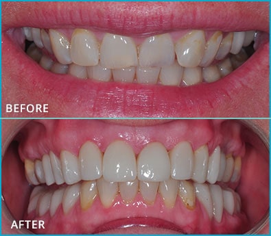 Before and After Case 44