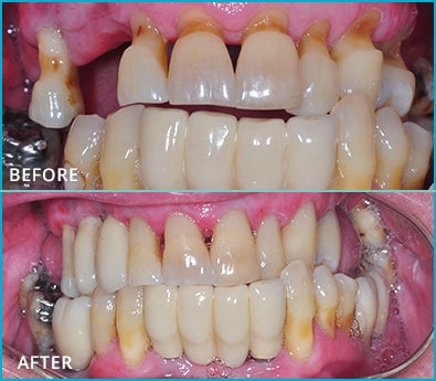 Before and After Case 45