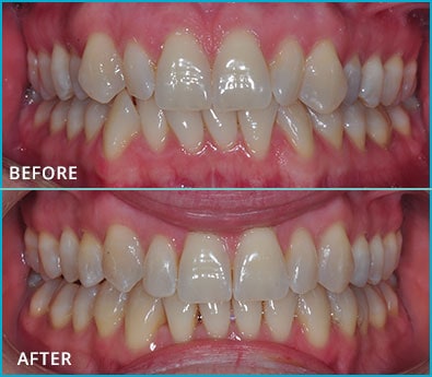 Before and After Case 46