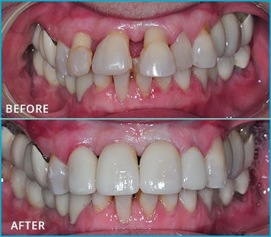 Before and After Case 47