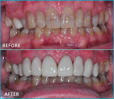 Before and After Case 48