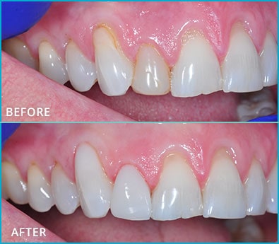 Before and After Case 49