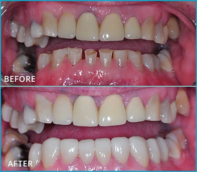 Before and After Case 50