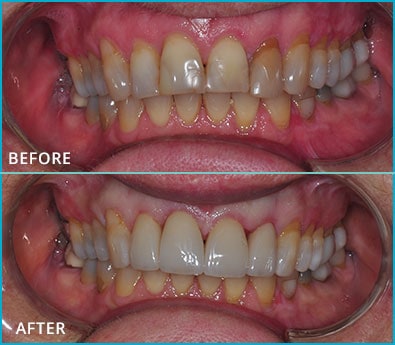 Before and After Case 42